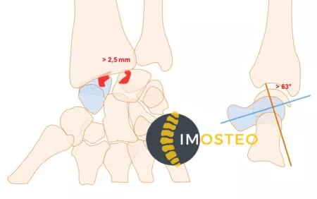 Visuel Imosteo d'une articulation osseuse