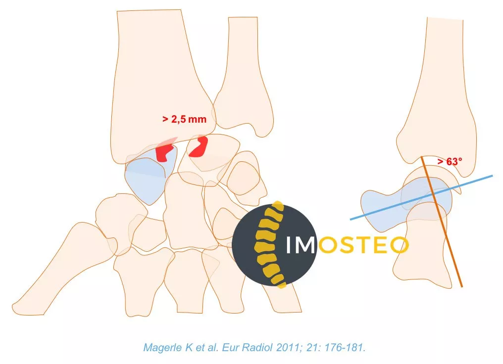 Visuel Imosteo d'une articulation osseuse